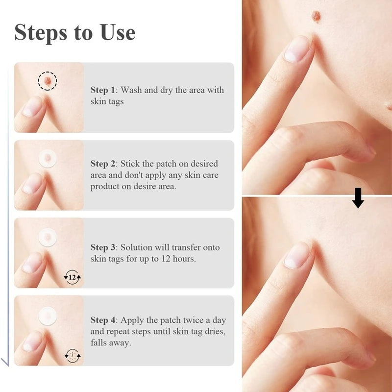 Skin Tag Removal Kit: All Natural & Hypoallergenic